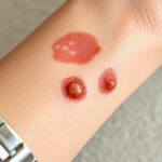 metal allergy contact dermatitis