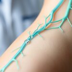 understanding and managing lymph leaks